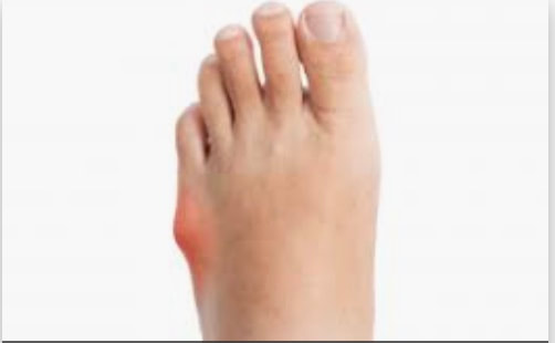 Bunions and hammer toes - KARR FOOT 