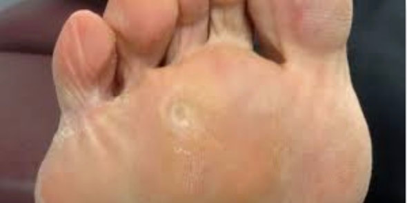 hard skin on side of foot hurts