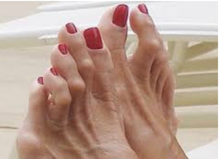 Bunions and hammer toes - KARR FOOT 
