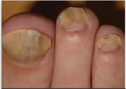 Yellow and thickened toes' nails with lymphedema