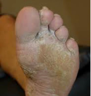 heel skin disease